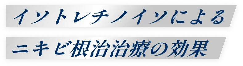イソトレチノイソによるニキビ根治治療の効果